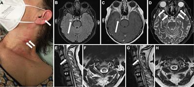 Treating seronegative neuromyelitis optica spectrum disorder with inebilizumab: a case report